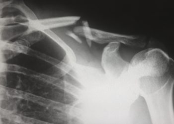 A shoulder X-ray