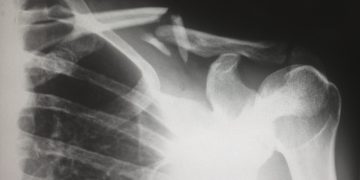 A shoulder X-ray