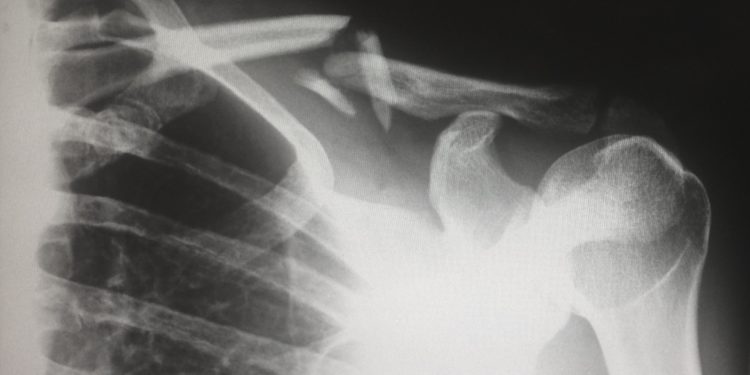 A shoulder X-ray